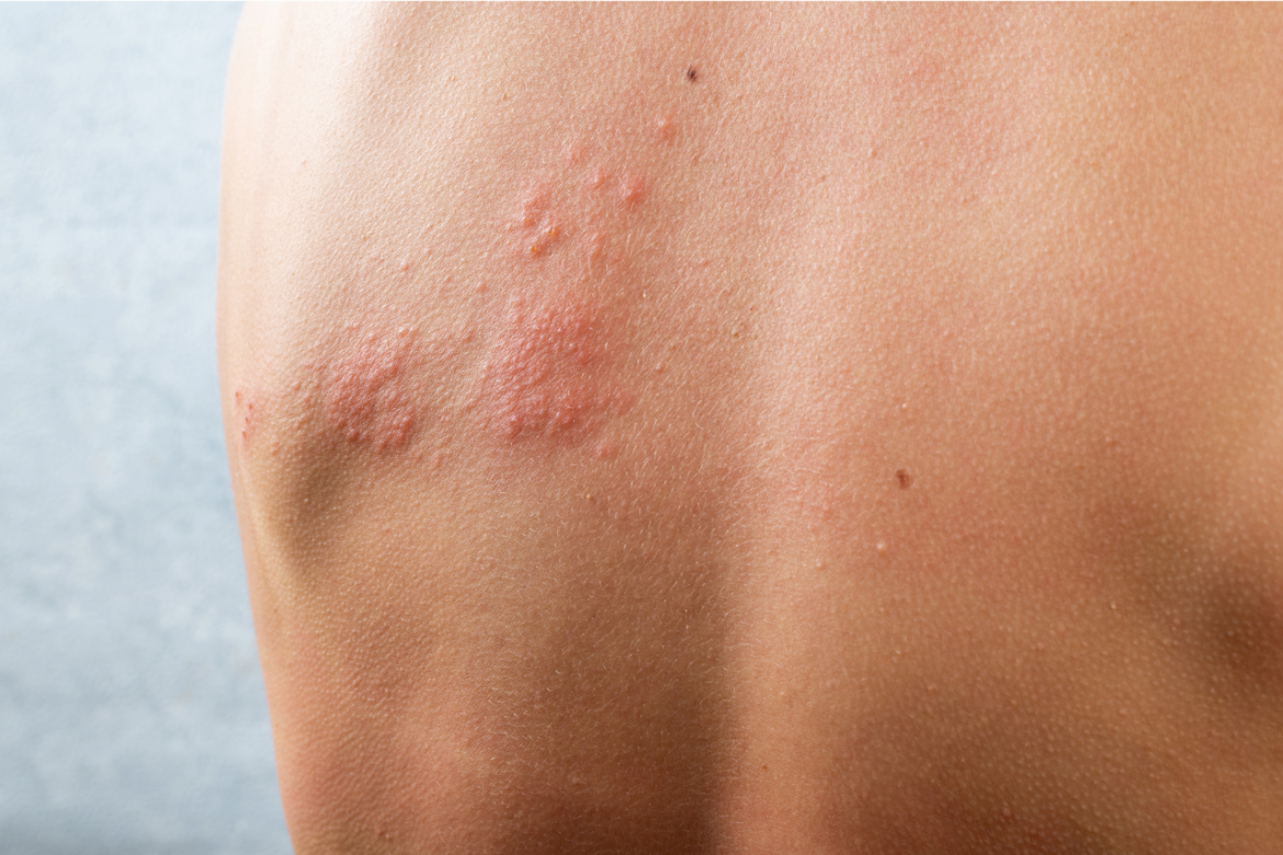 herpes_zoster_free.png