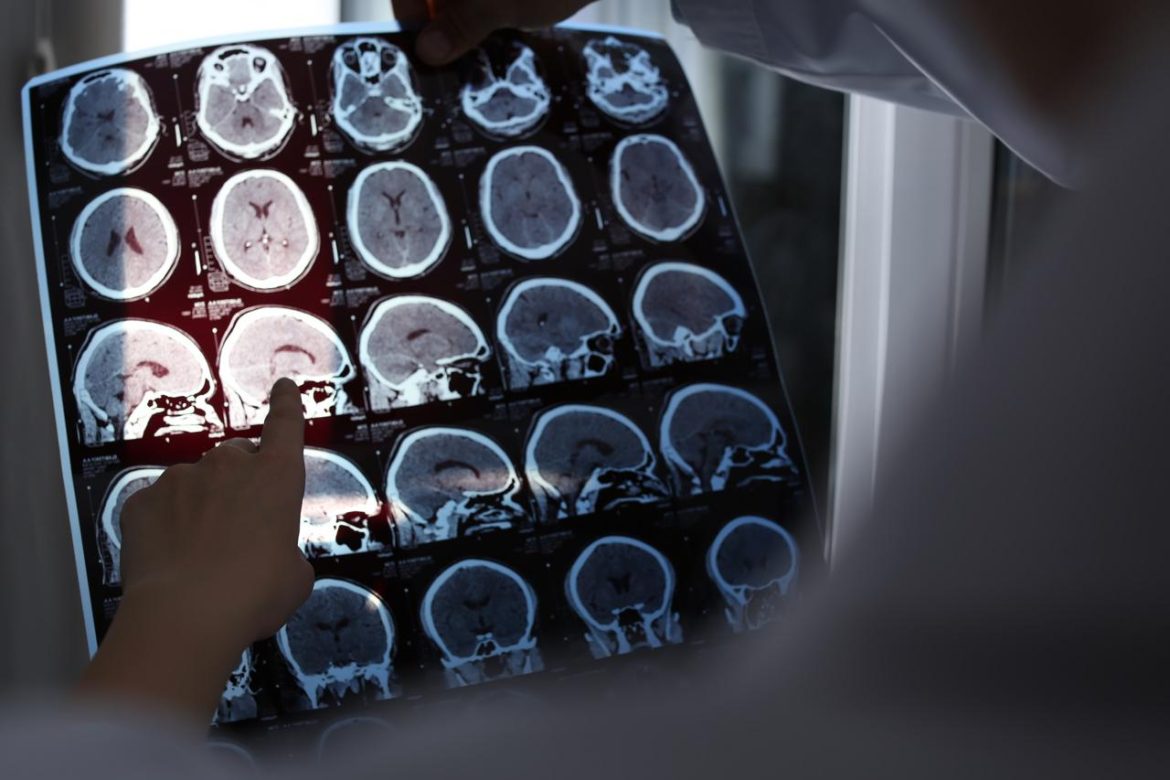 lastre_cervello_Alzheimer_123RF.jpg