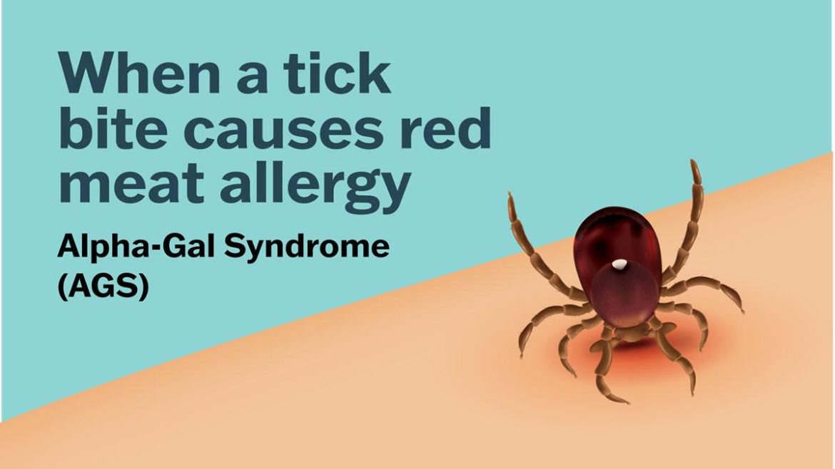 when-tick-bite-causes-red-meat-allergy-ags.jpg