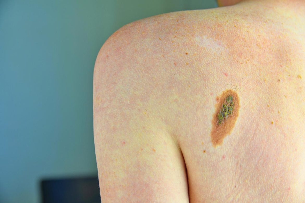 melanoma_free.jpeg